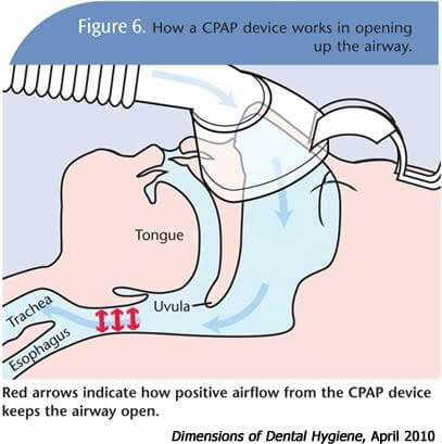 CPAP hay phẫu thuật OSA là hai phương pháp điều trị ngưng thở khi ngủ được bác sĩ cân nhắc dựa trên từng trường hợp cụ thể.